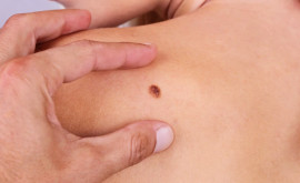 În Moldova numărul cazurilor de cancer de piele este în creștere