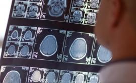 В Канаде люди страдают от неизвестного заболевания поражающего мозг 