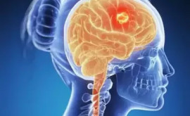 A fost găsit un remediu neașteptat împotriva cancerului cerebral