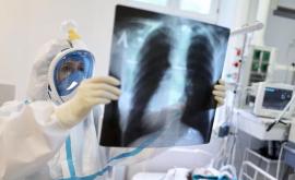  Leziunile pulmonare descoperite la pacienţi decedaţi dezvăluie informaţii despre COVIDul de lungă durată