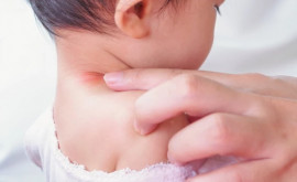 Dermatita atopică la bebeluși cauze și tratament