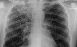 În țară vor fi implementate tehnologii noi de diagnostic al tuberculozei