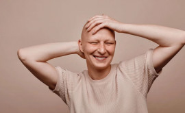 Alopecia severă căderea părului ar putea fi tratată cu un medicament comun pentru artrită
