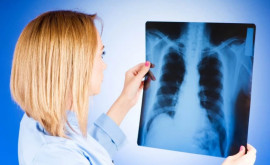 В столице выявлены четыре случая заболевания туберкулезом