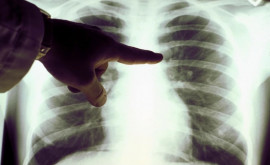 Numărul persoanelor care suferă de cancer pulmonar în creștere
