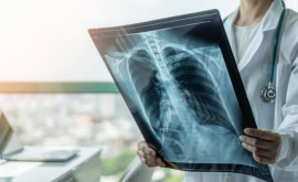 Пульмонолог В Молдове каждые четыре часа регистрируется случай туберкулеза