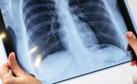 Растет число больных туберкулезом