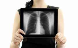 Imagini ce te pot sensibiliza Prima gură de aer după operația de transplant pulmonar