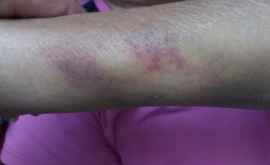 Bolnavi agresați fizic și înfometați la spitalul de psihiatrie din Orhei