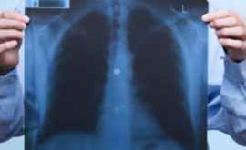 Как часто можно делать рентгенографию легких 