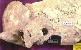 A fost găsit un craniu de 1600 de ani cu urme de operație chirurgicală cerebrală complicată
