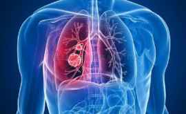 После пандемии COVID19 может наступить всплеск туберкулеза