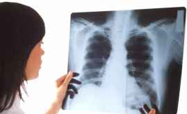 Oamenii de știință au descoperit mecanismul de autodistrugere a tuberculozei