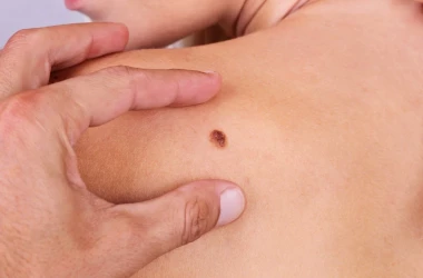 În Moldova numărul cazurilor de cancer de piele este în creștere