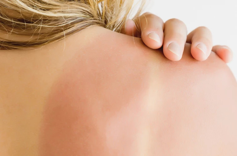 Cinci remedii simple și eficiente pentru a calma pielea inflamată și dureroasă de arsurile solare