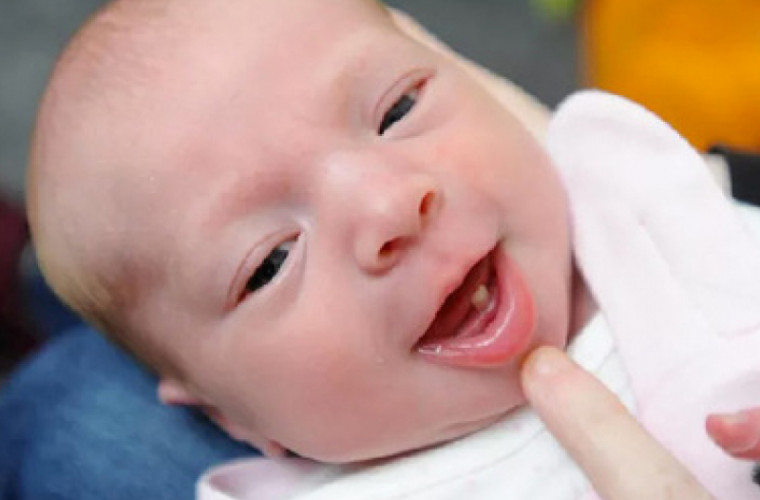 Un copil s-a născut cu un dinte de lapte 