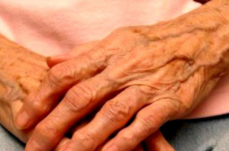O femeie a trăit 99 de ani cu o afecțiune extrem de rară