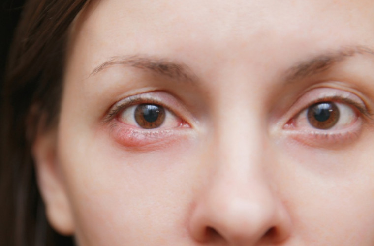 ce sa faci daca ai ulcior la ochi inflamația ochilor afectează vederea